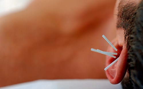 Ear acupuncture